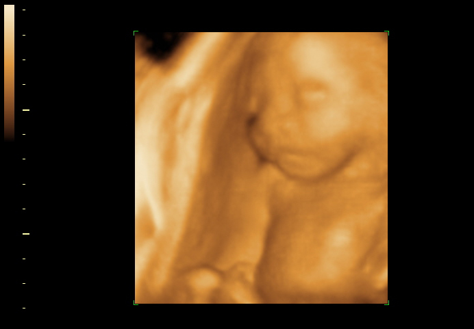 3D ultrasound image at 23 weeks